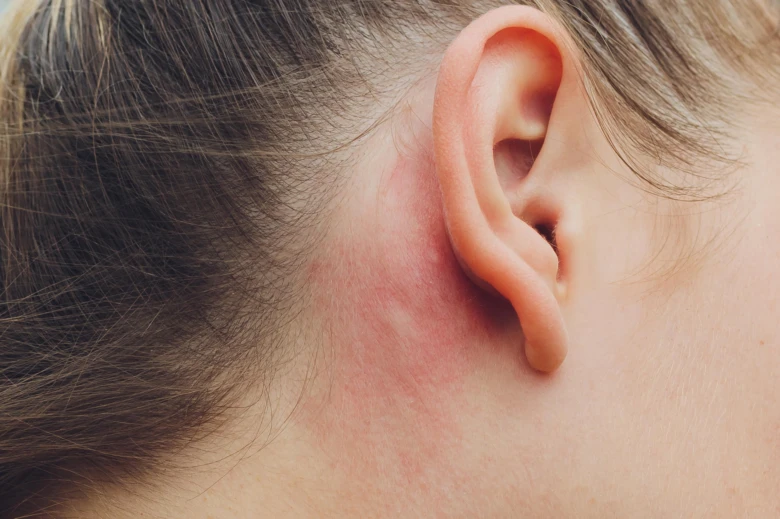 Červená podrážděná kůže za uchem při kontaktní dermatitidě.