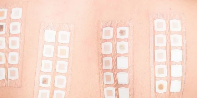Skin patch test results