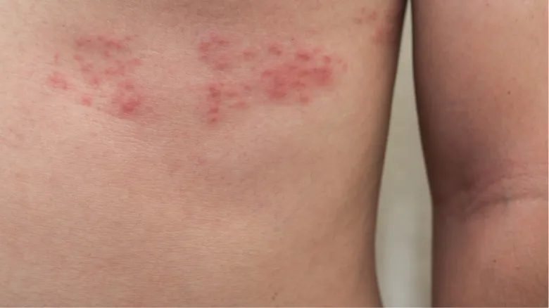 Child hives rash