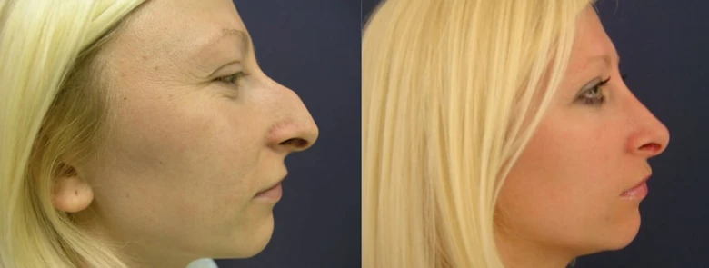Nose profile before and after surgery