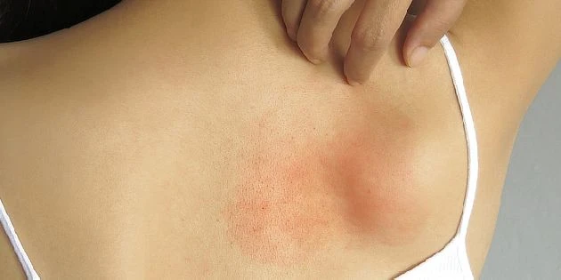 Červené podráždění kůže na zádech způsobené kontaktní dermatitidou.