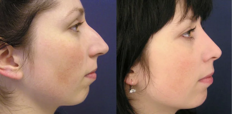 Nose profile before after