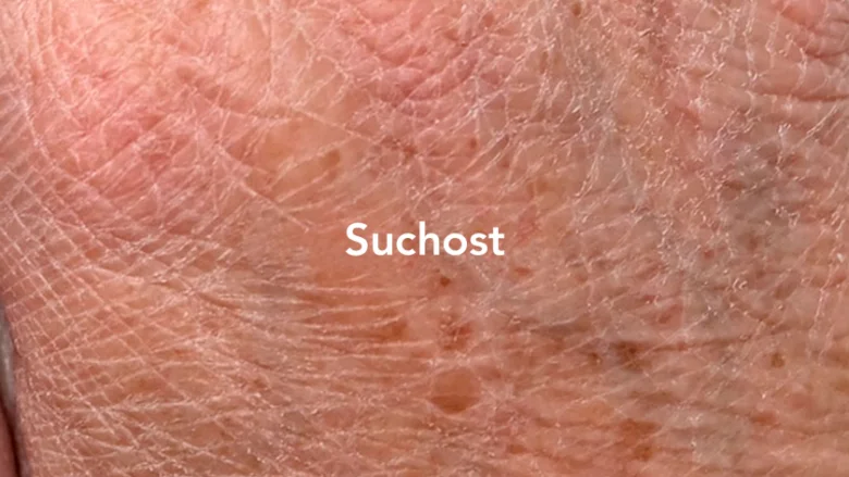 Dry irritated skin