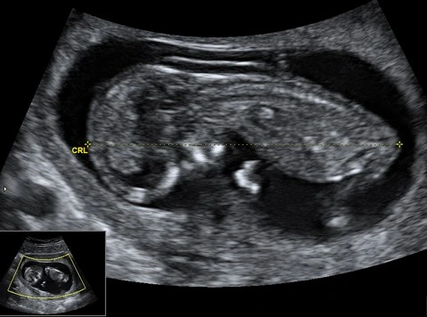 Ultrazvukový snímek plodu v 13 týdnu těhotenství s měřením.