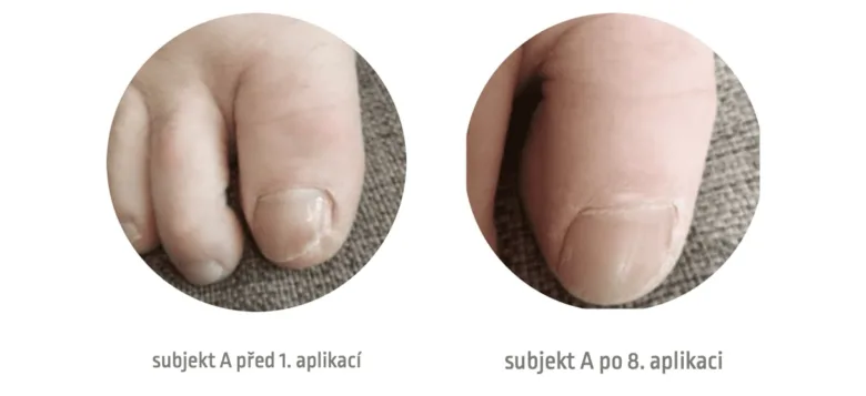 Porovnání nehtu před léčbou plísně po osmi aplikacích produktu.
