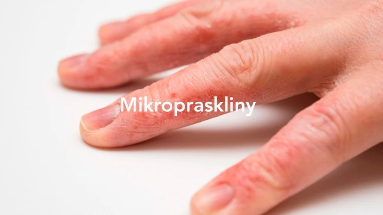 Rozšíření podrážděné kůže na prstech ruky.