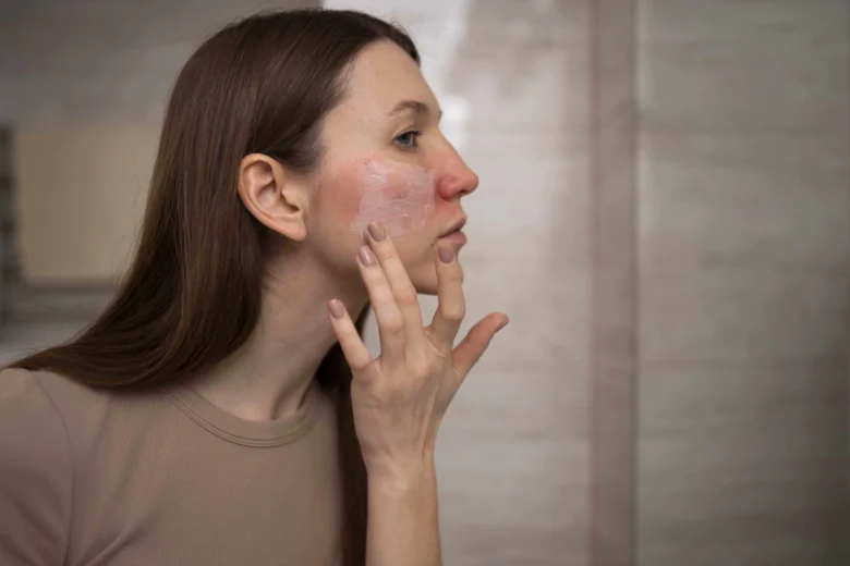 Woman applying cream to red face