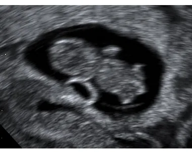 Fetus in uterus ultrasound